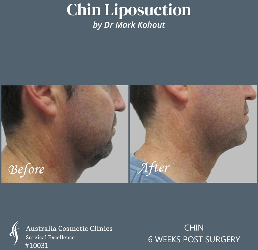 Chin Liposuction Patient 10031 SIDE