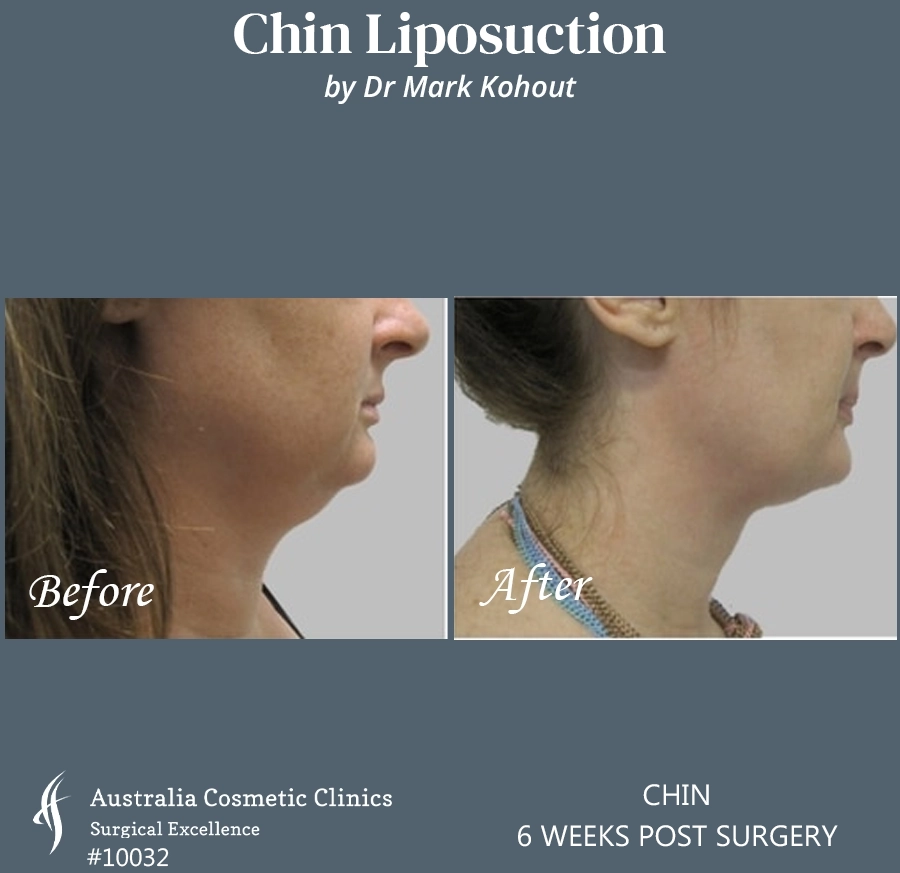 Chin Liposuction Patient 10032 LEFT SIDE