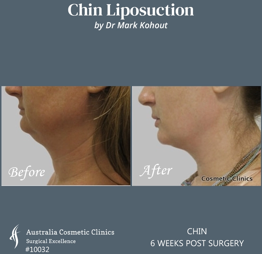 Chin Liposuction Patient 10032 RIGHT SIDE