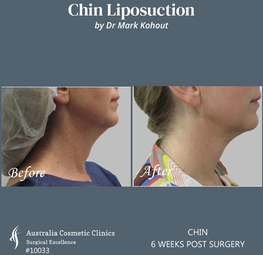 Chin Liposuction Patient 10033 SIDE
