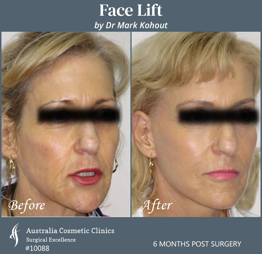 Facelift Patient 10088 45