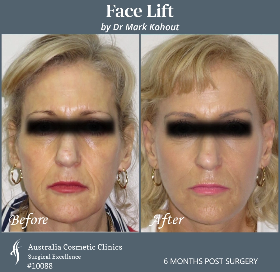 Facelift Patient 10088 Front