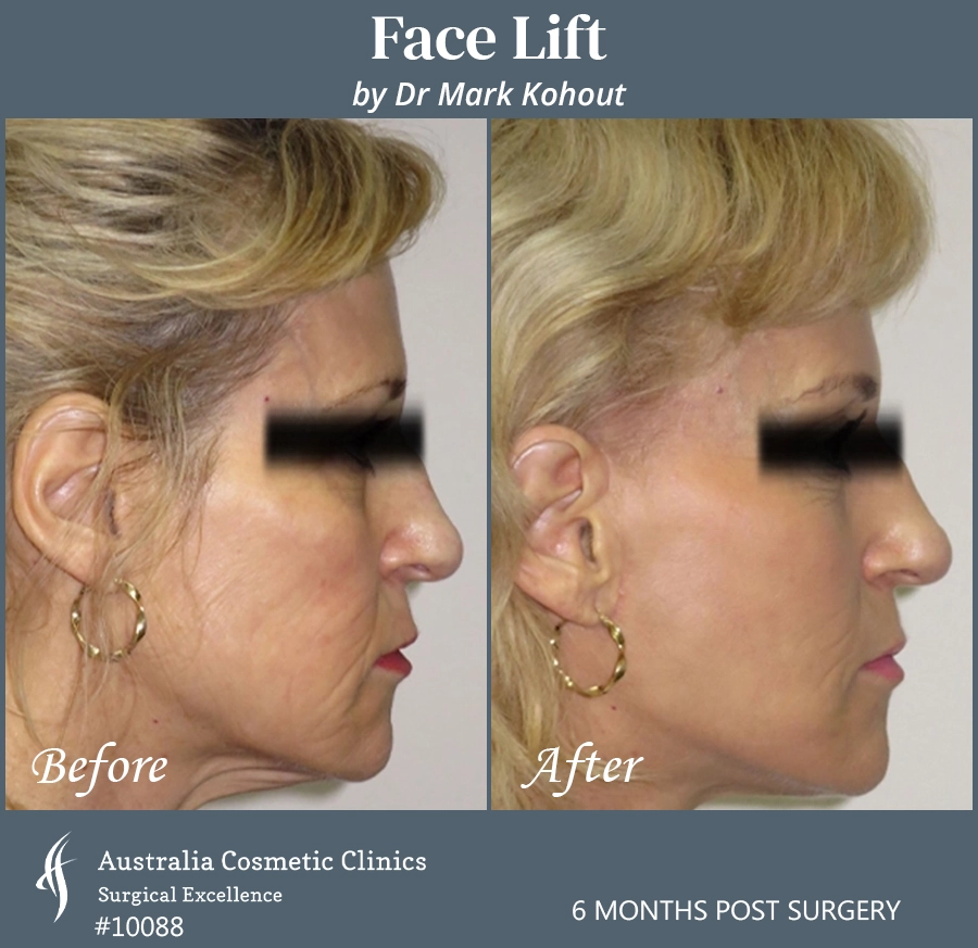 Facelift Patient 10088 Side
