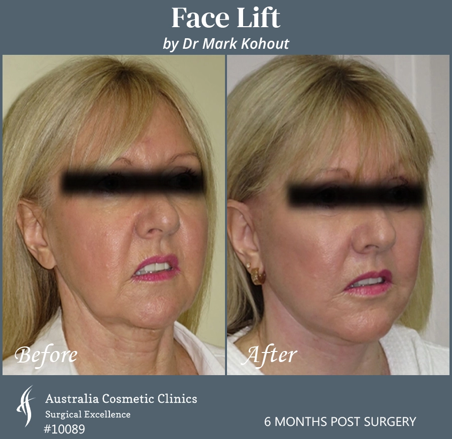 Facelift Patient 10089 45