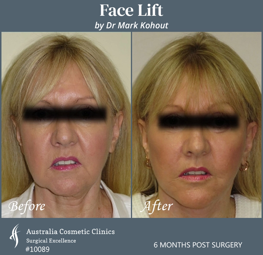 Facelift Patient 10089 Front