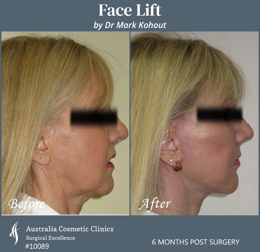 Facelift Patient 10089 Side