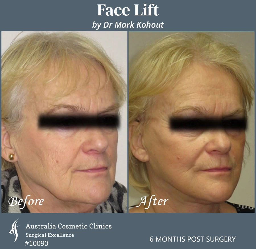 Facelift Patient 10090 45