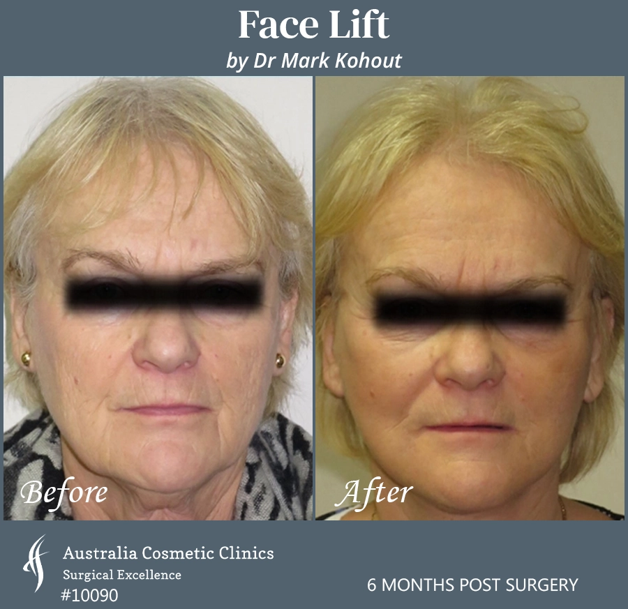 Facelift Patient 10090 Front