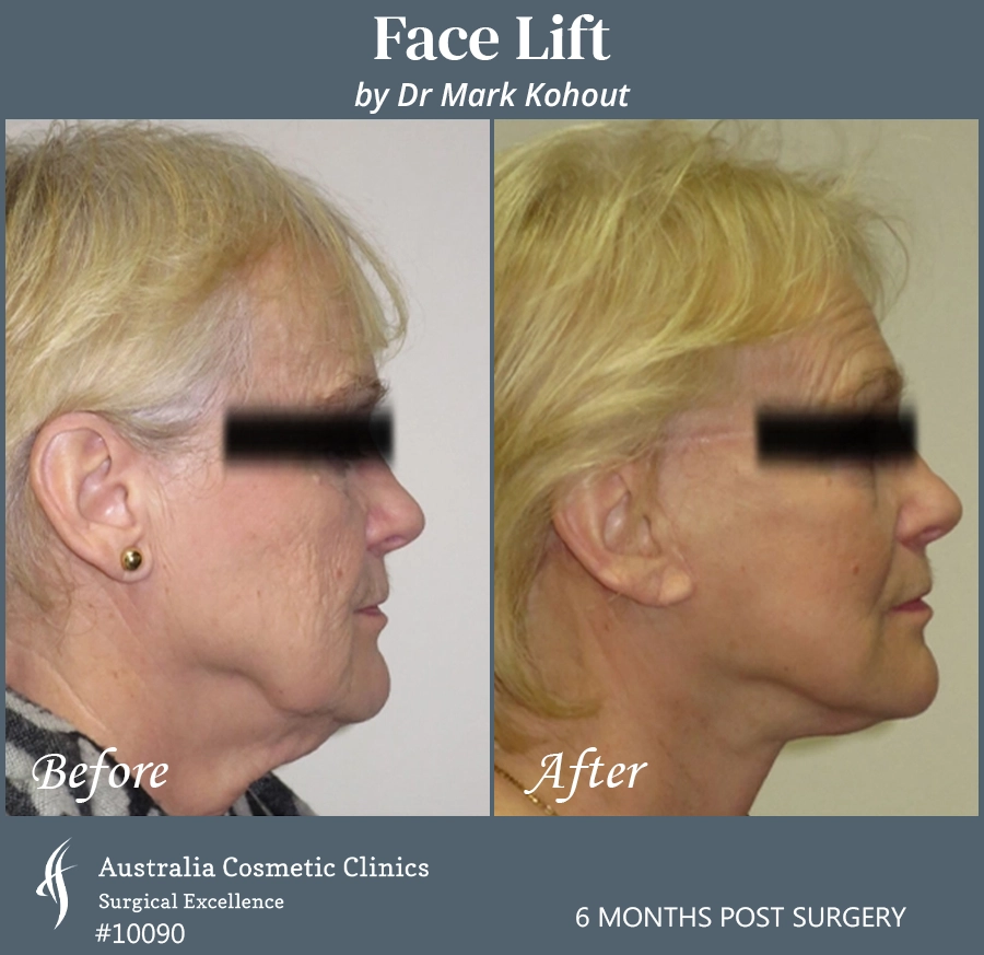 Facelift Patient 10090 Side