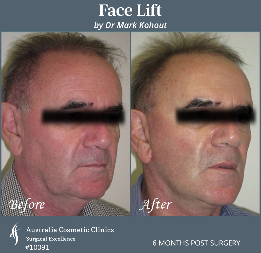 Facelift Patient 10091 45