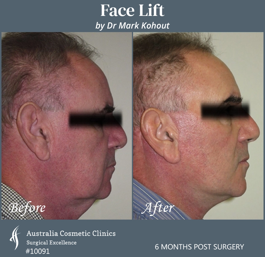Facelift Patient 10091 Side