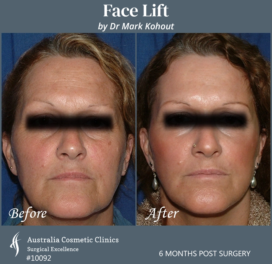 Facelift Patient 10092 Front