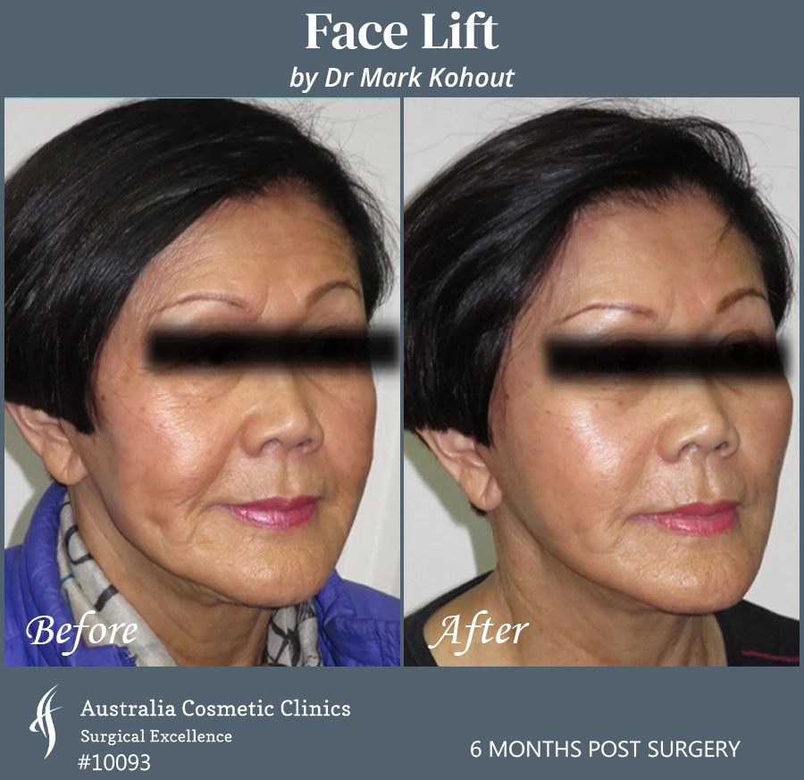 Facelift Patient 10093 45