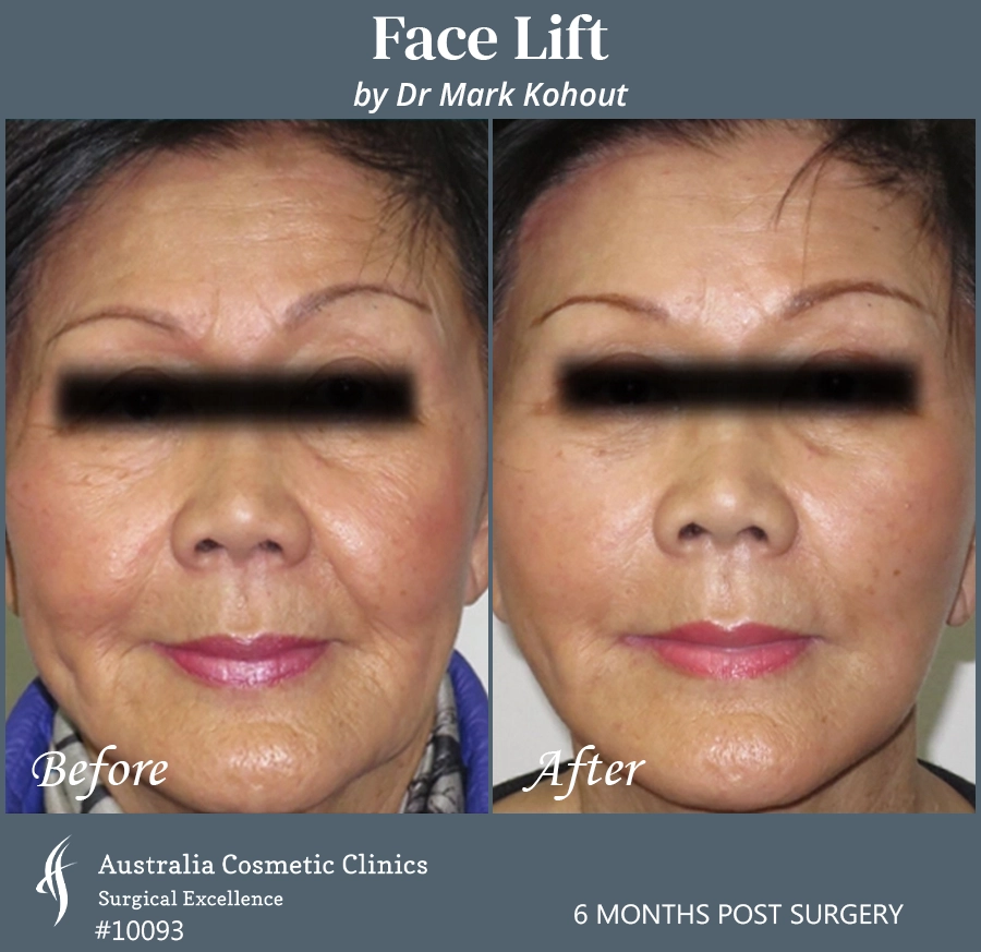 Facelift Patient 10093 Front