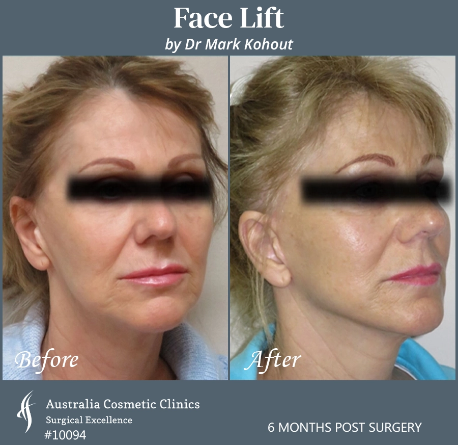 Facelift Patient 10094 45