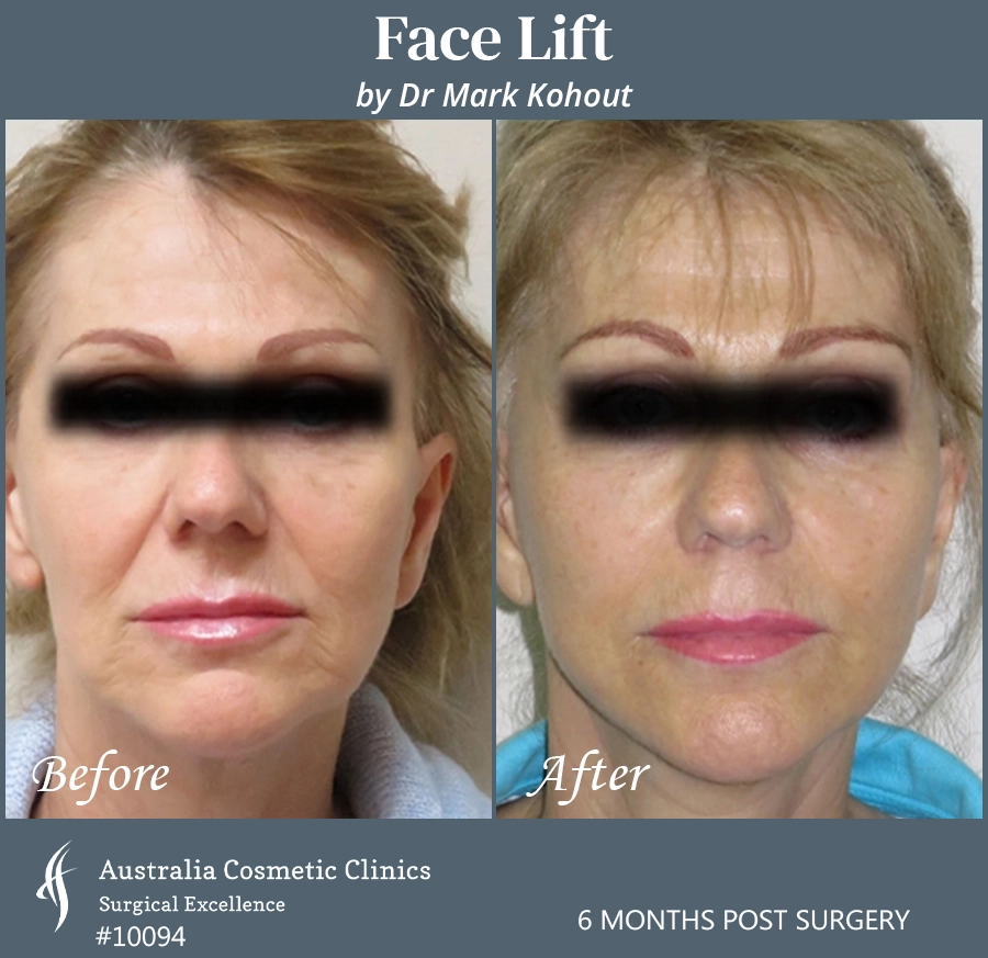 Facelift Patient 10094 Front