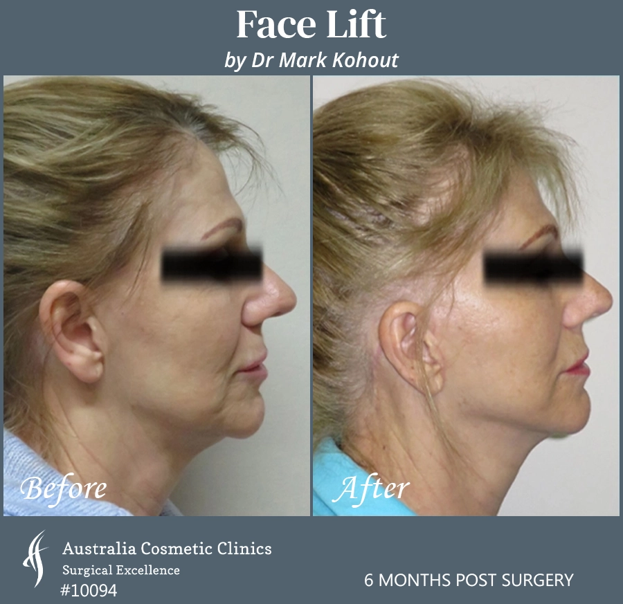 Facelift Patient 10094 Side