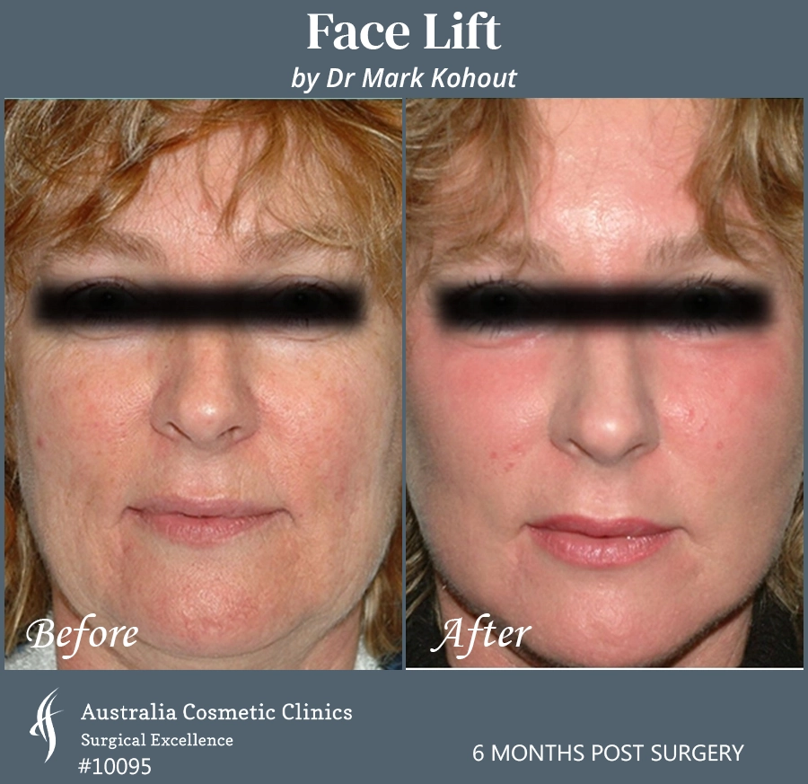 Facelift Patient 10095 Front