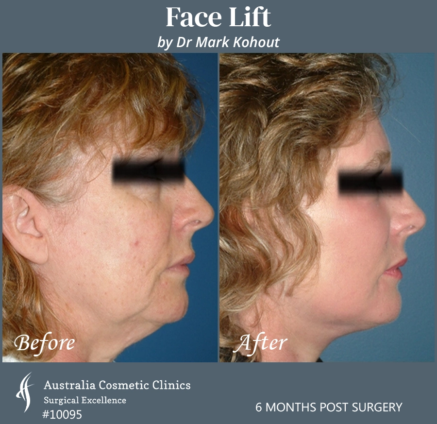 Facelift Patient 10095 Side