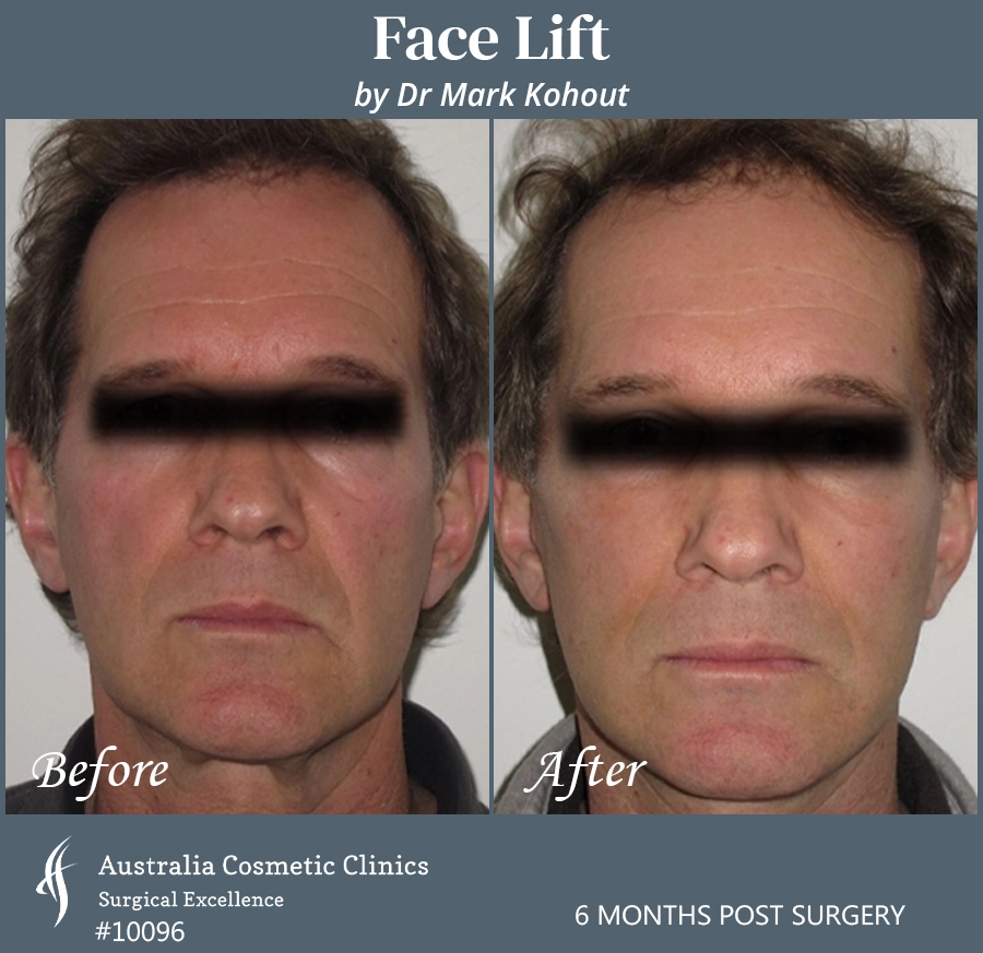 Facelift Patient 10096 Front