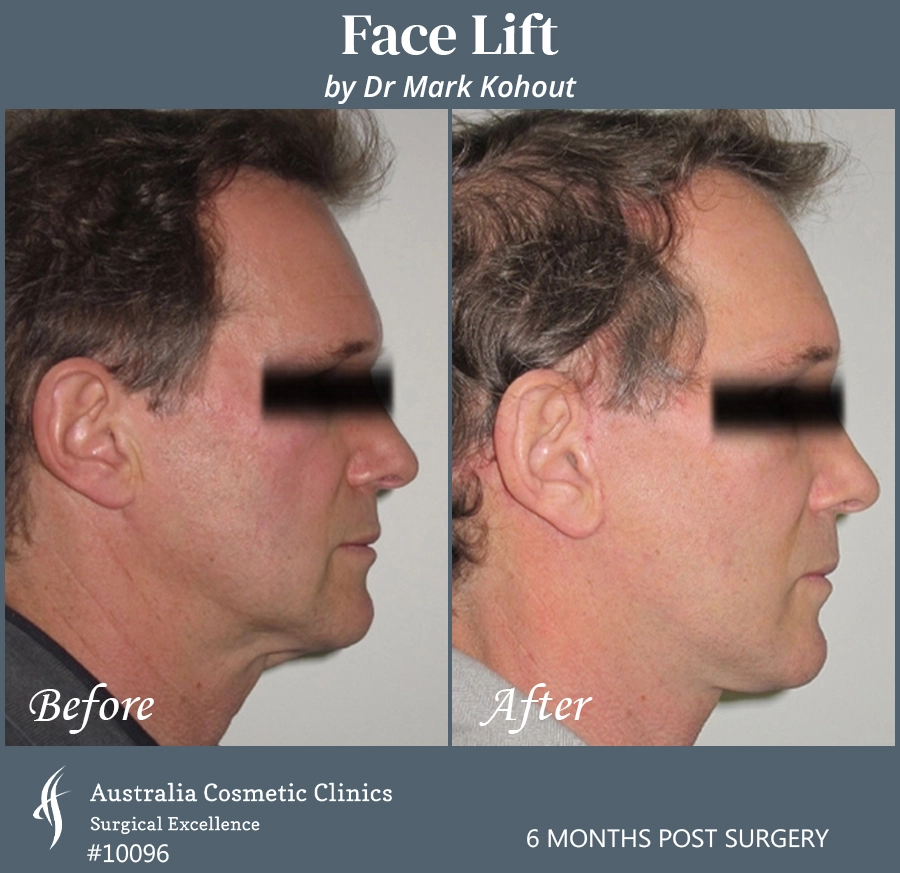 Facelift Patient 10096 Side