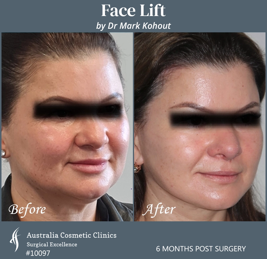 Facelift Patient 10097 45