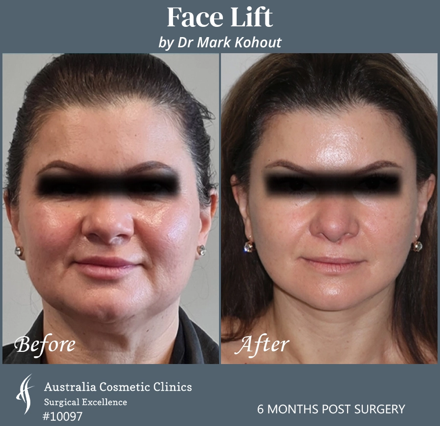 Facelift Patient 10097 Front
