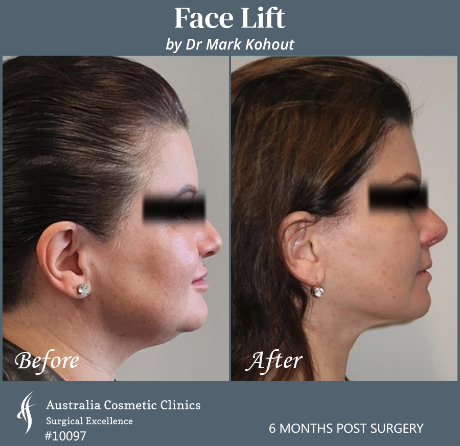 Facelift Patient 10097 Side