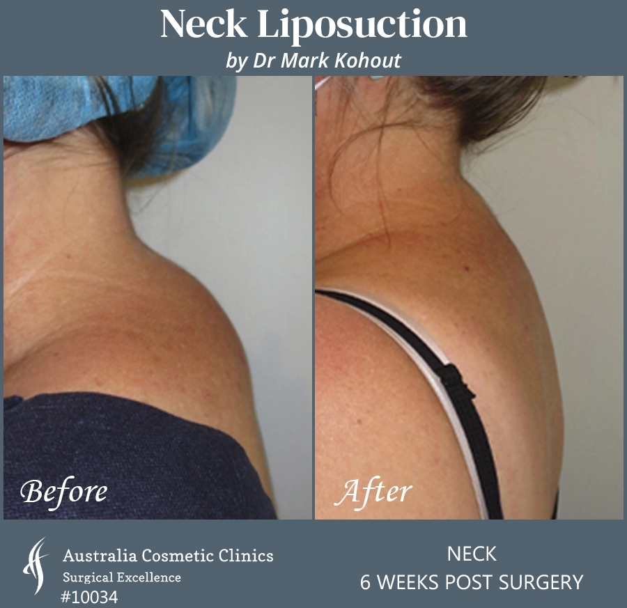 Neck Liposuction Patient 10034 SIDE