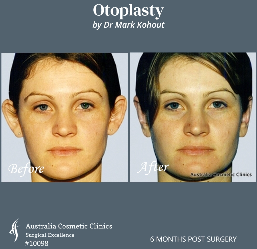 Otoplasty Patient 10098 Front