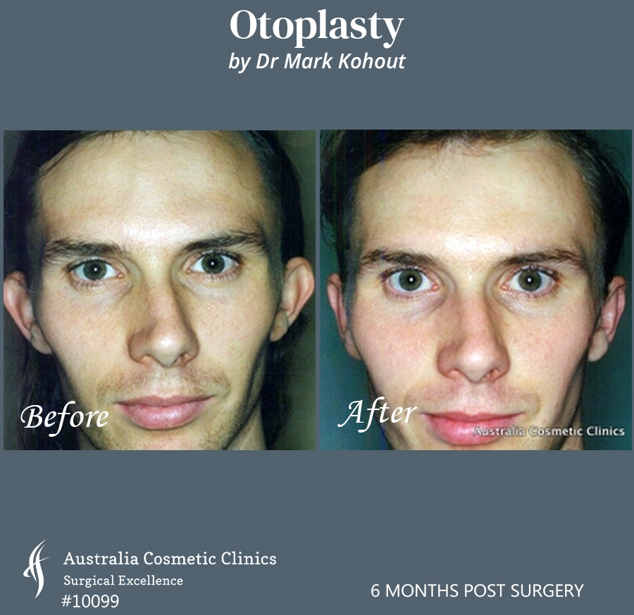 Otoplasty Patient 10099 Front