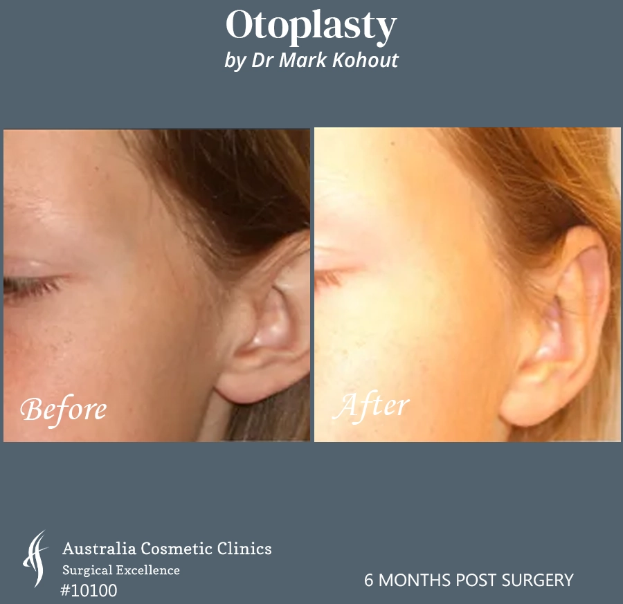 Otoplasty Patient 10100 45
