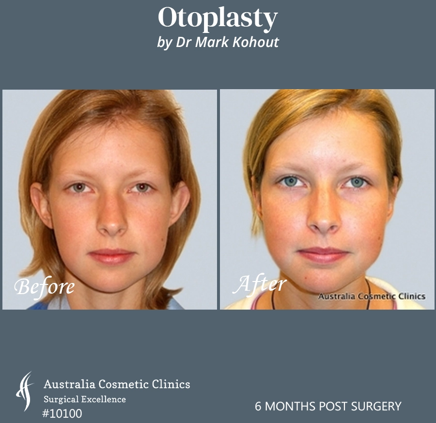 Otoplasty Patient 10100 Front