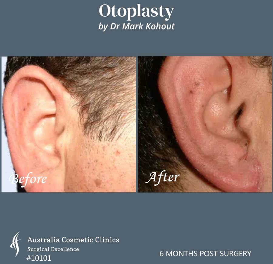 Otoplasty Patient 10101 Front