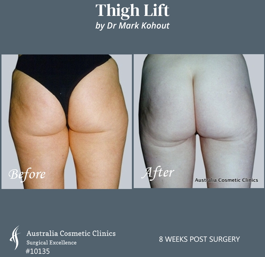 Thigh Lift Patient 10135 Back