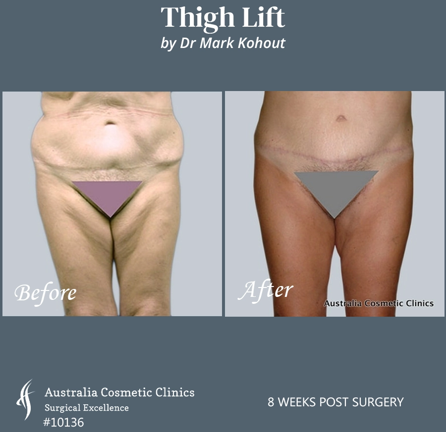 Thigh Lift Patient 10136 Front