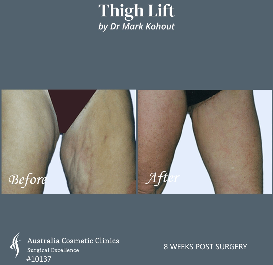 Thigh Lift Patient 10137 45