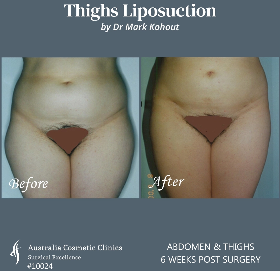 Thigh Liposuction Patient 10024 FRONT