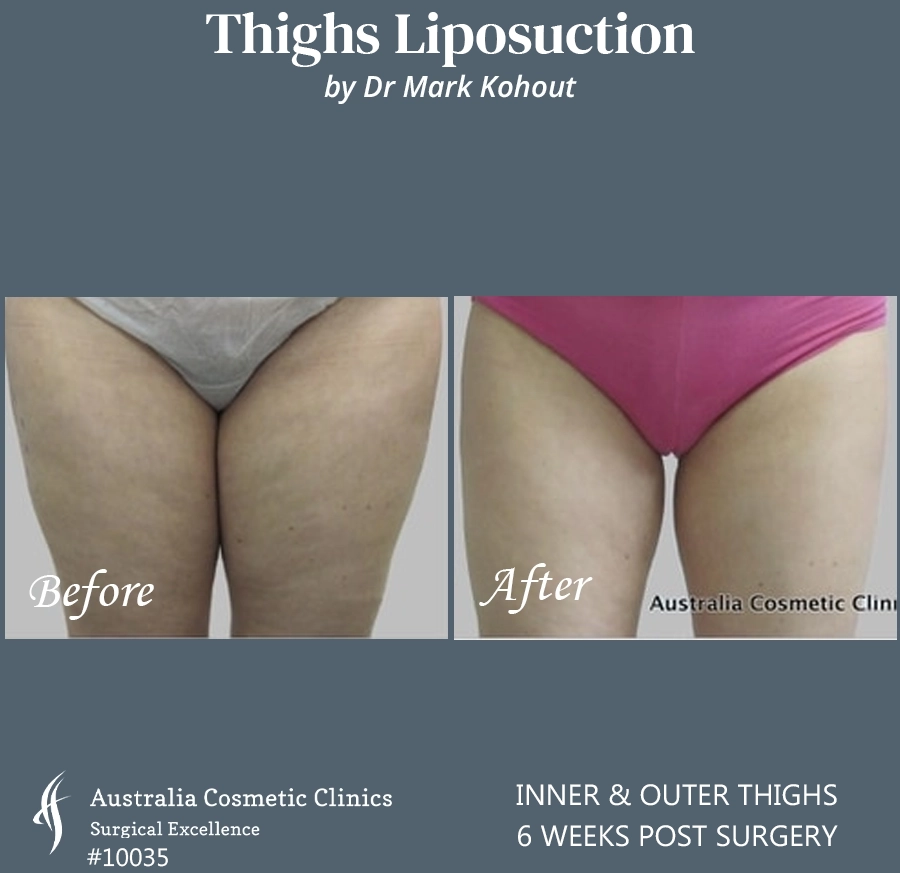 Thigh Liposuction Patient 10035 FRONT
