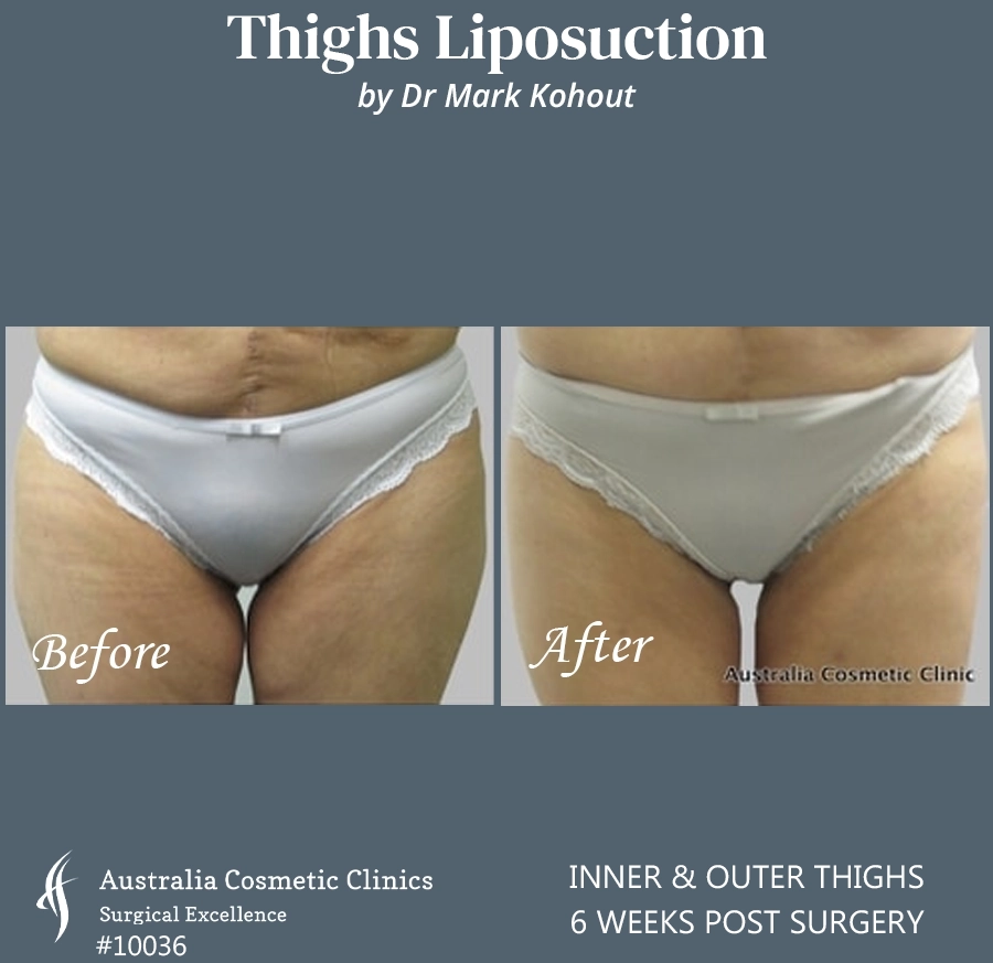 Thigh Liposuction Patient 10036 FRONT
