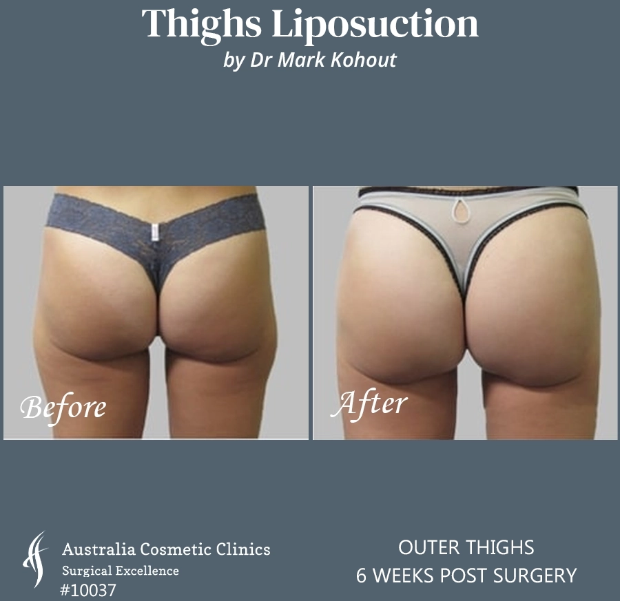 Thigh Liposuction Patient 10037 BACK