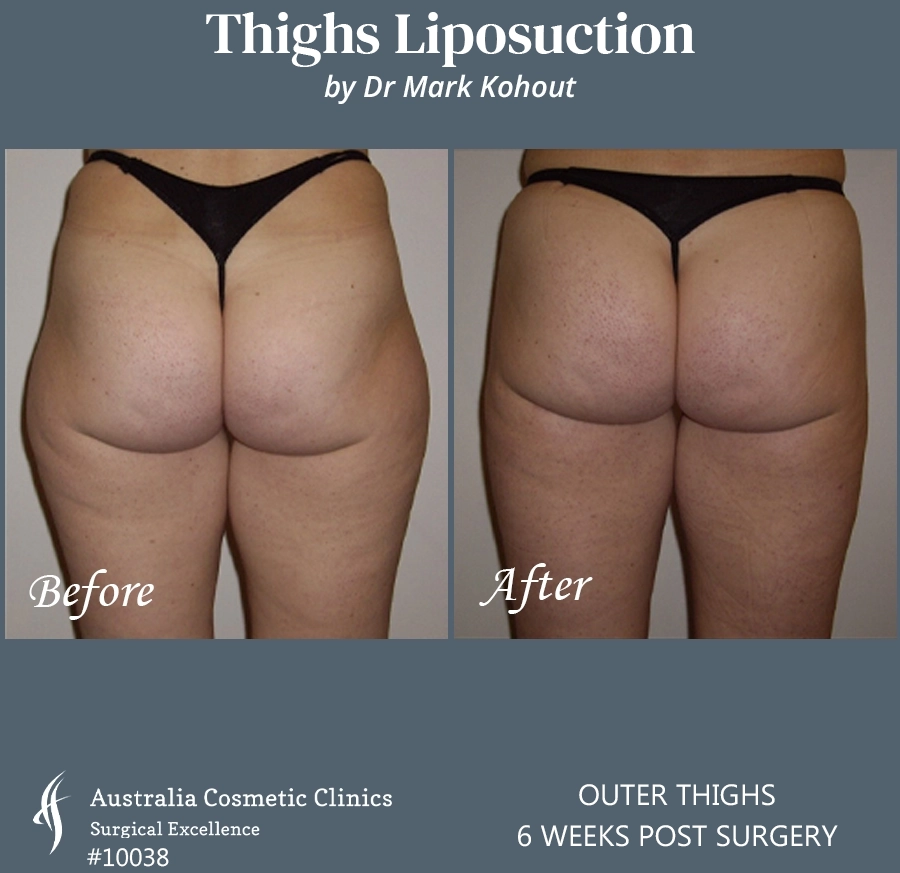 Thigh Liposuction Patient 10038 BACK