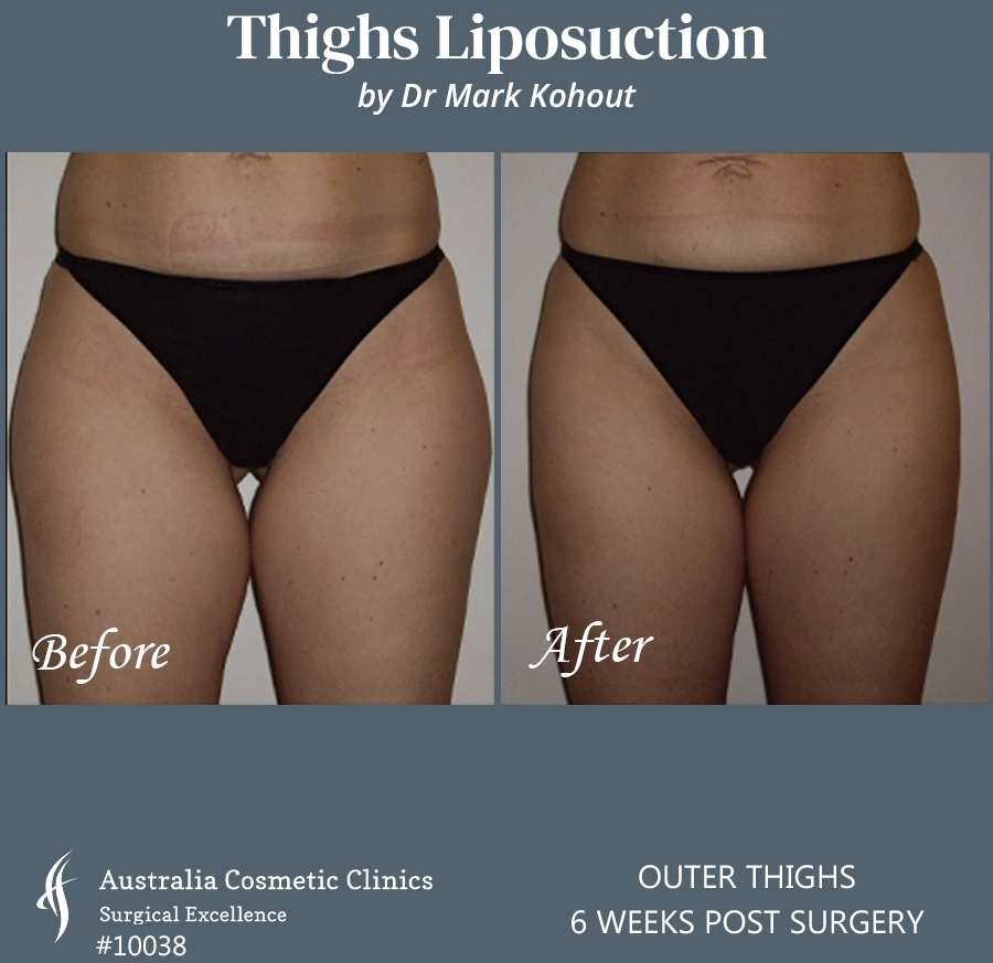 Thigh Liposuction Patient 10038 FRONT