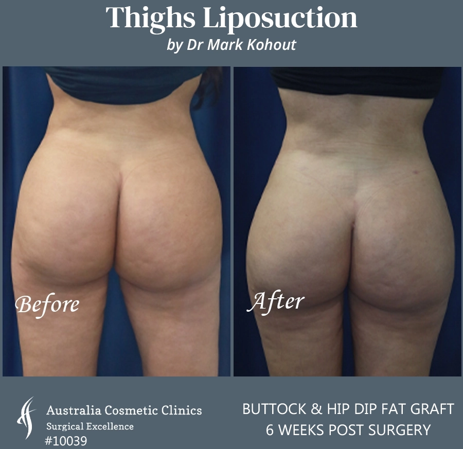 Thigh Liposuction Patient 10039 BACK