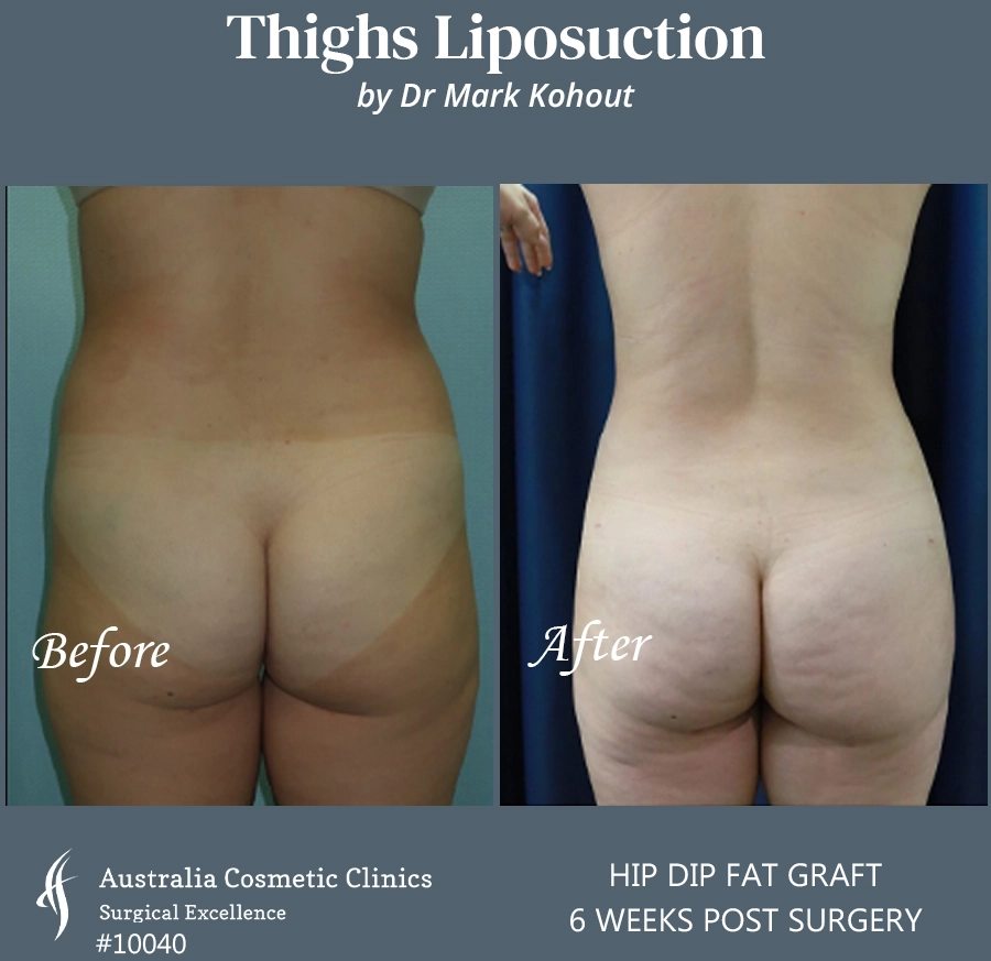 Thigh Liposuction Patient 10040 BACK