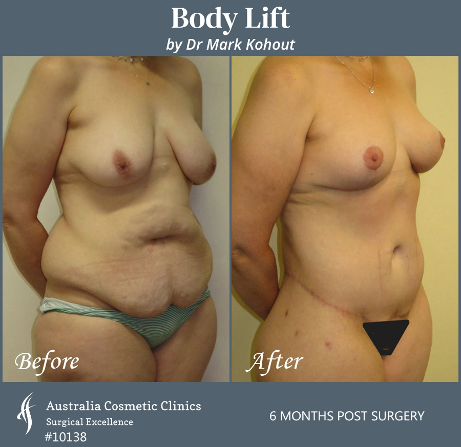 Body Lift Patient 10138 45