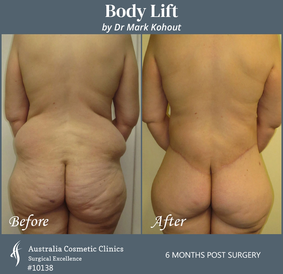 Body Lift Patient 10138 Back