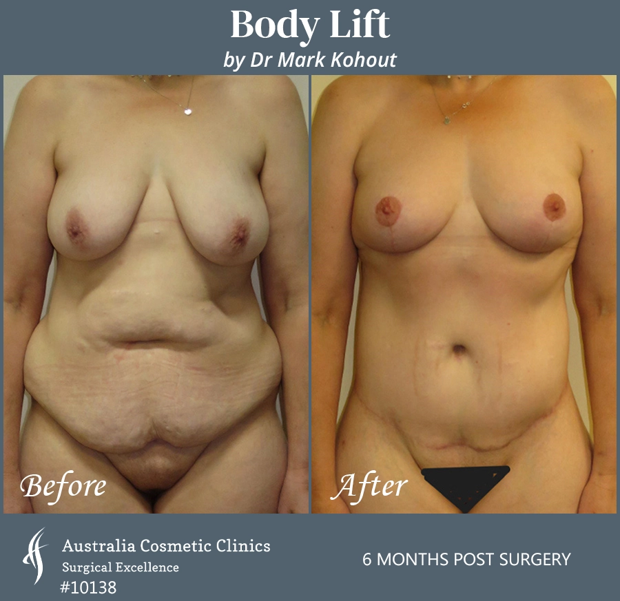 Body Lift Patient 10138 Front