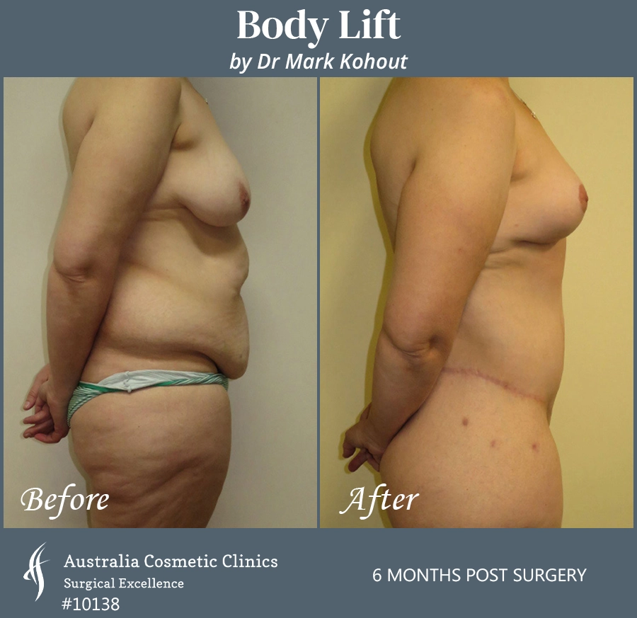 Body Lift Patient 10138 Side