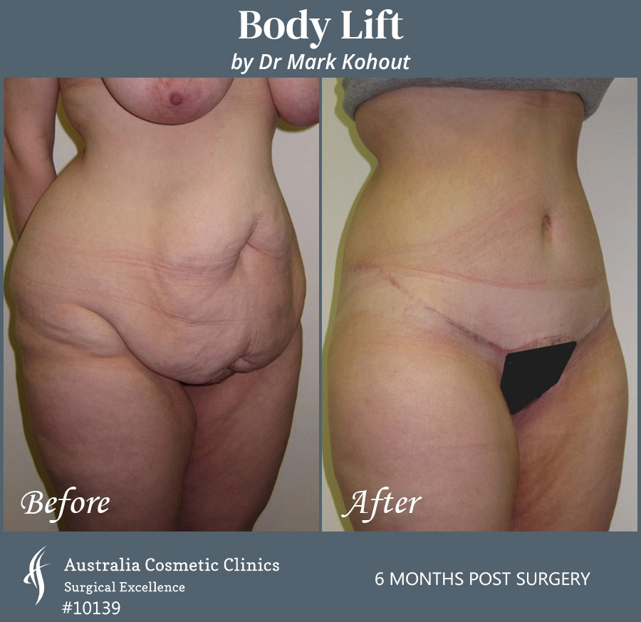 Body Lift Patient 10139 45